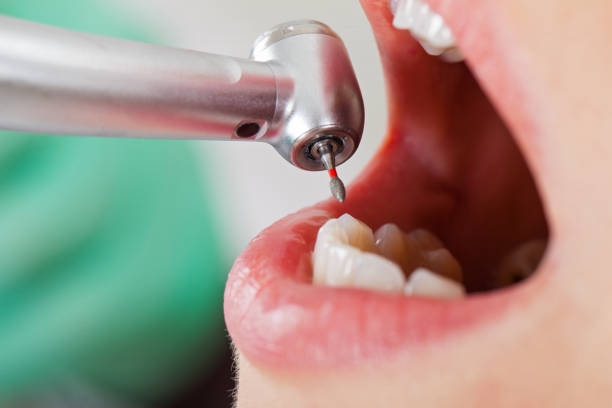 Best Emergency Dentist for Lost Fillings or Crowns in Wiggins, MS